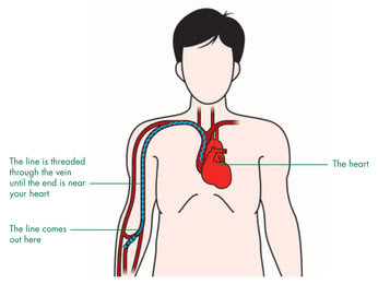 35+ Trends For Drawing Blood From Picc Line With Tpn | Creative Things