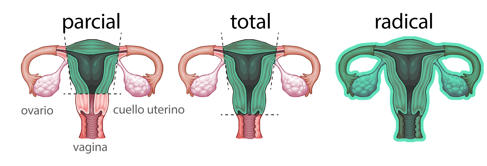 Resultado de imagen para histerectomia ginecologica
