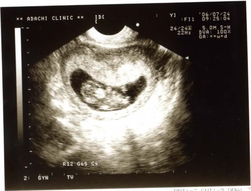 [最も選択された] 中期 中絶 胎児 画像 186171