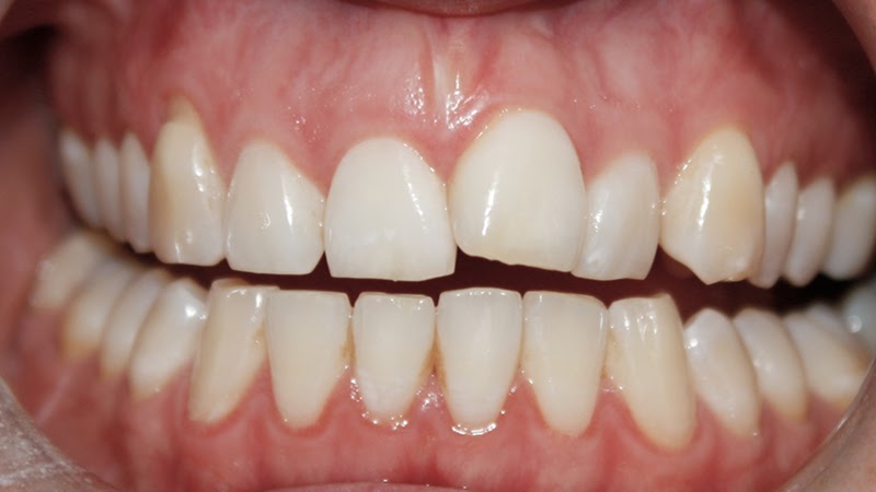 Dente Encavalado Da Frente - Natsu Wallpaper
