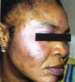 images DESTROY YOUR SKIN AND END UP WITH SKIN CANCER!BLEACH AND DIE!