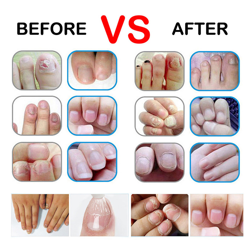 32+ Infection Acrylic Nail Fungus Pictures Gif - best acrylic for