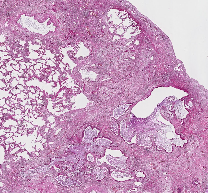 Патанатомия. Эмфизема легкого гистология. Крупозная пневмония гистология. Межуточная пневмония гистология. Эмфизема легкого макропрепарат патанатомия.