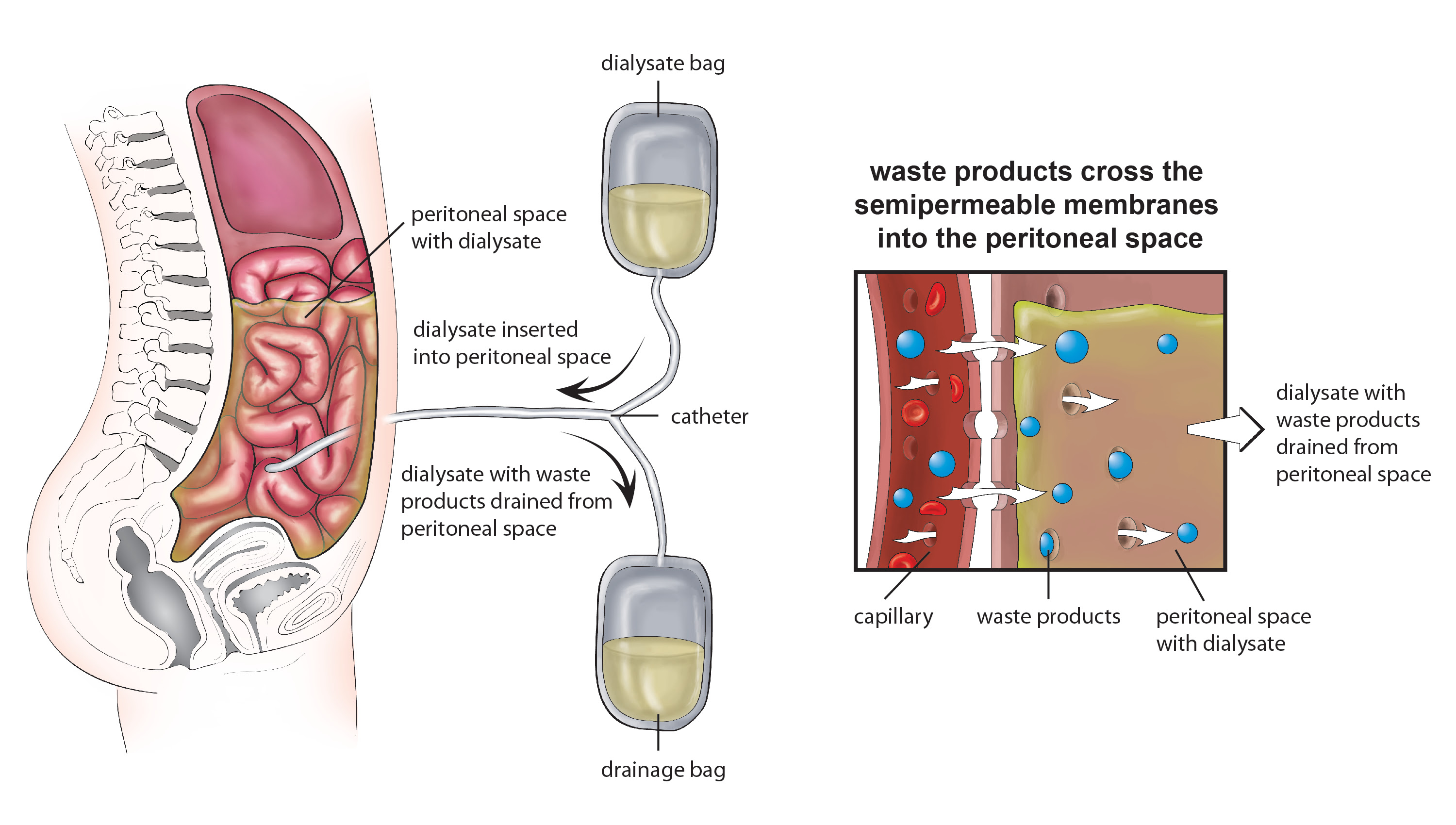 is-it-really-possible-to-get-off-kidney-dialysis-kidney-disease