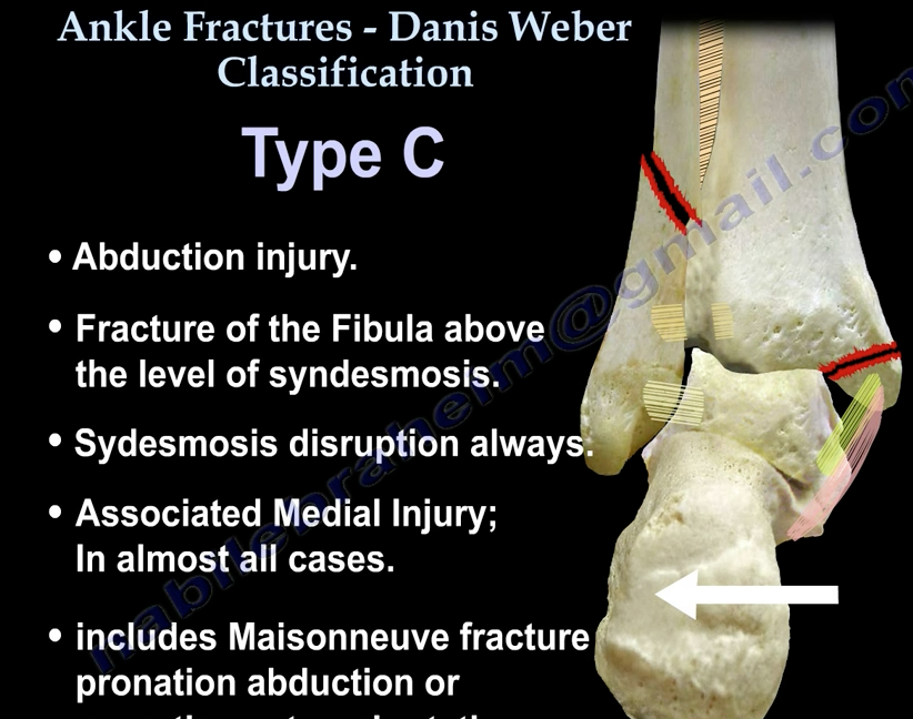 Weber Classification Ankle