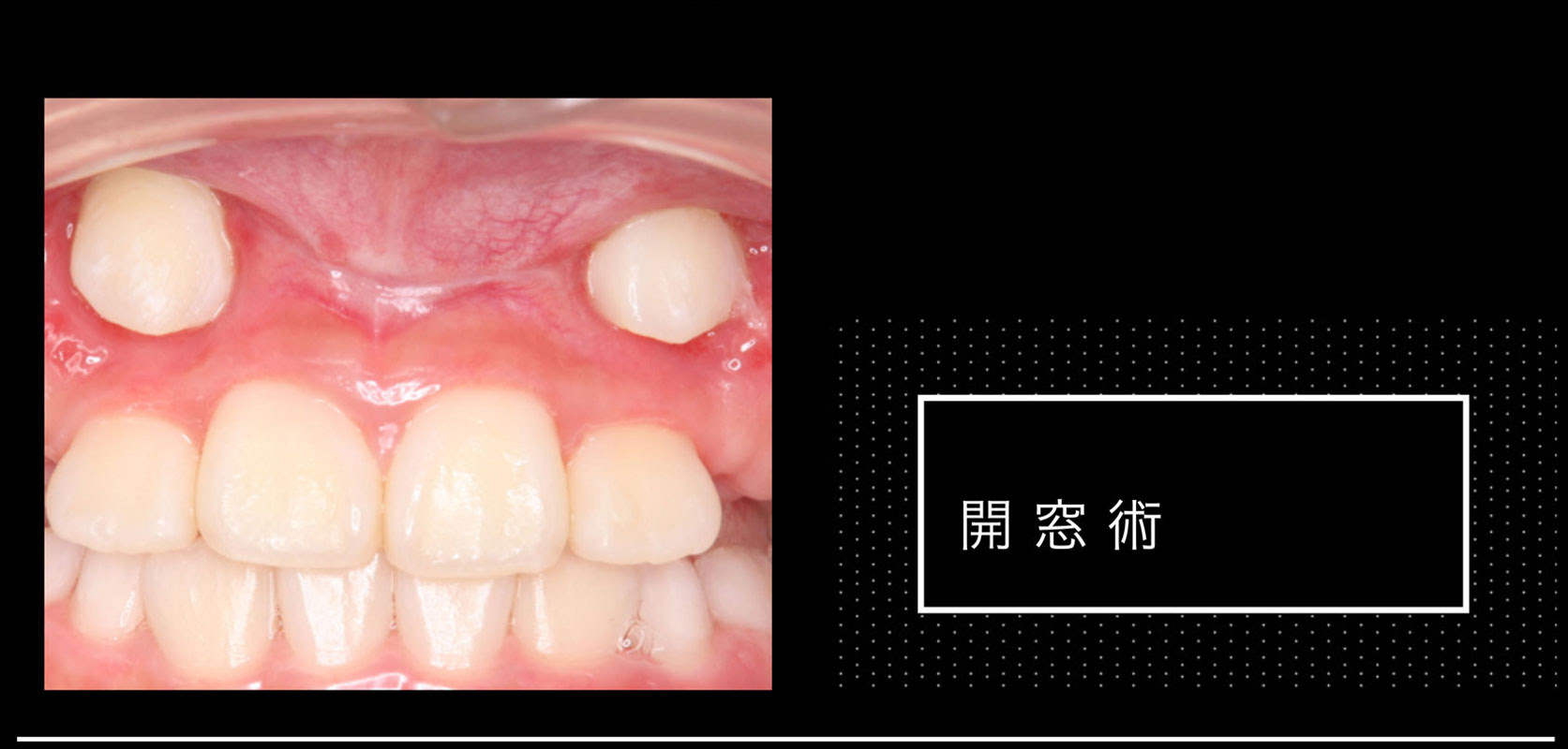 開 窓 術 歯科 術 式 skybexzt