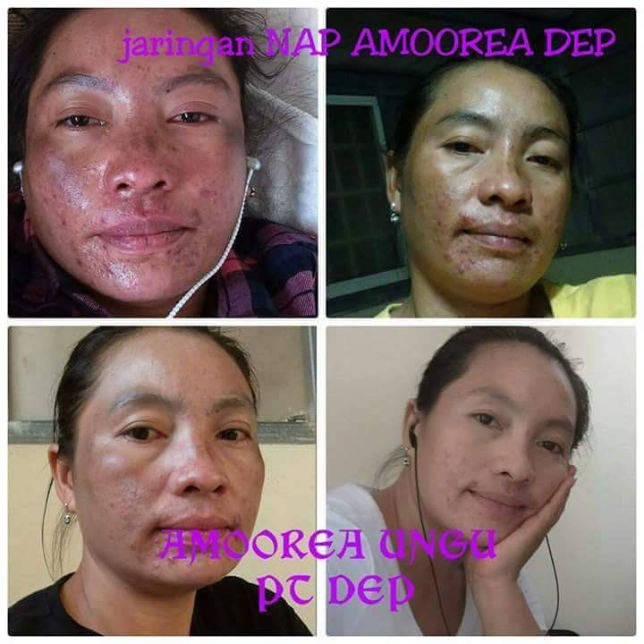Foto Testimonial Pemakaian Amoorea Foto Testimonial Pemakaian Amoorea
