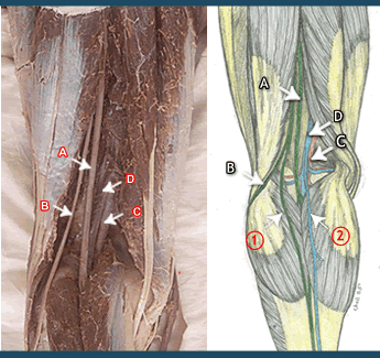 Lymphedema of the leg: Popliteal lymph nodes