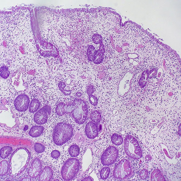 Hyperplastic Polyp Pathology Outlines