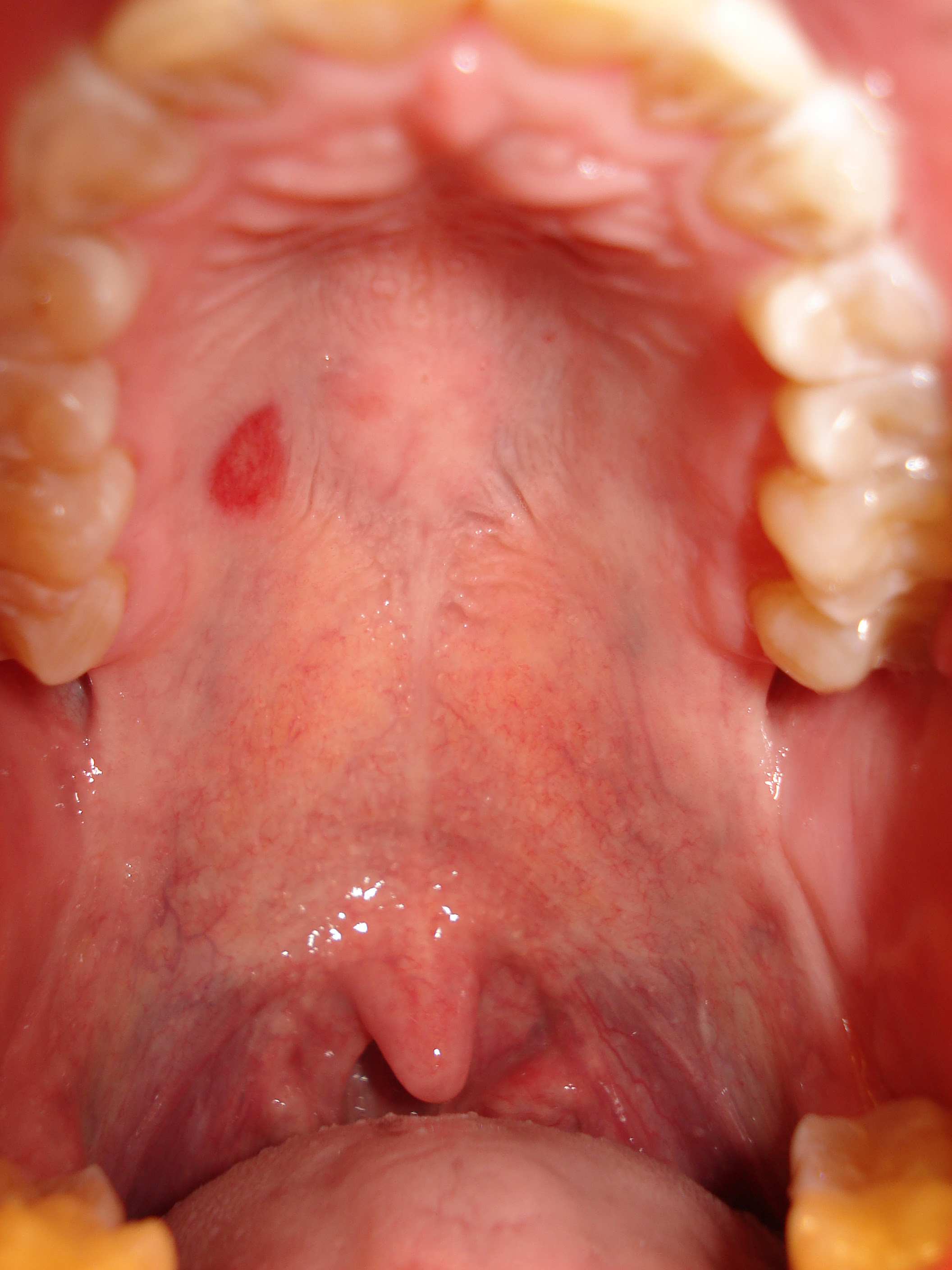 roof-of-mouth-swelling-behind-front-teeth-prnso