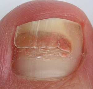 Front Doors: Cracked toenail repair