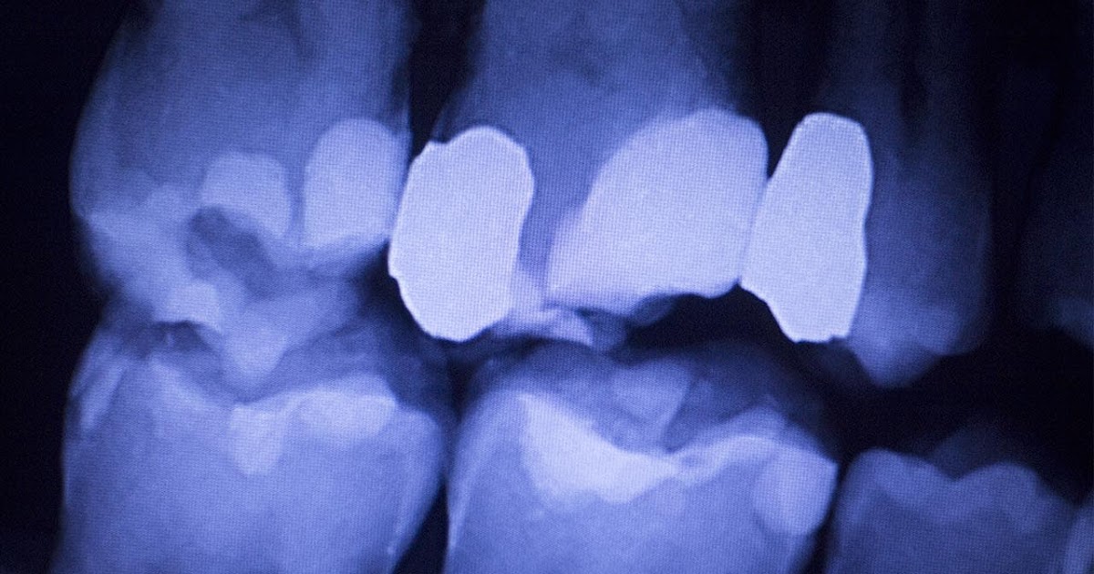 How Much Is Dental Filling Without Insurance / How Much