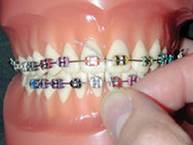 braces flossing