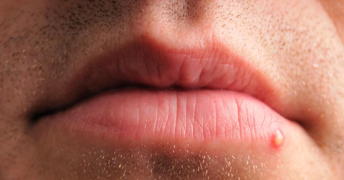 How To Treat Infected Blackhead On Lip HOWTORMEOV