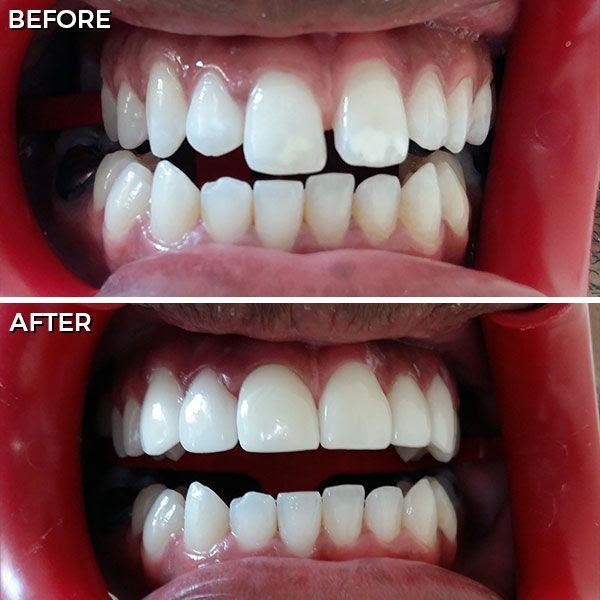 How Much Does Veneers Cost In Mexico - WHMUC