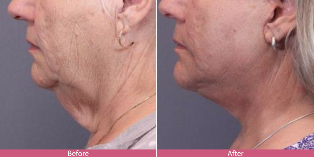 saggy-neck-from-weight-loss-weightlosslook