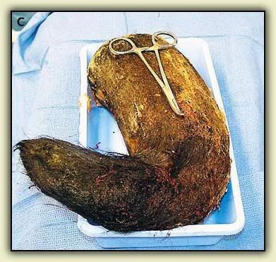 Trichobezoar