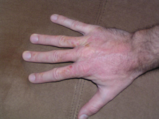 nysobukyfi: poison oak pictures of rash
