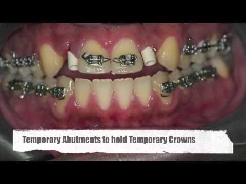 wykm: how to pull a rotten tooth