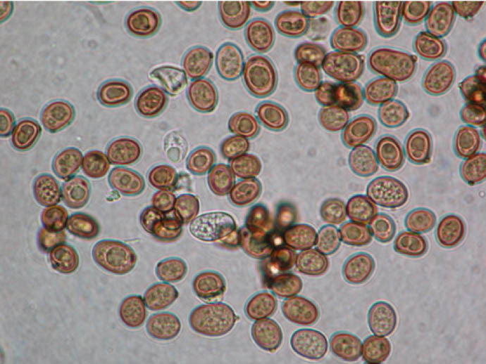 На коже обнаружены споры. Микроскопия кала дрожжи. Микроскопия кала дрожжевые грибки. Споры грибов в Кале микроскопия. Споры грибов под микроскопом в Кале.