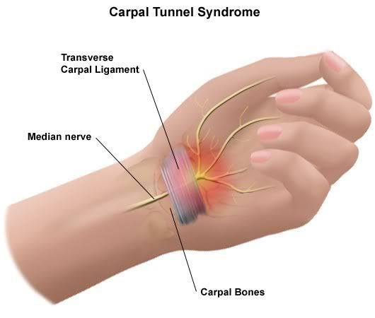 Carpal Tunnel Syndrome Health