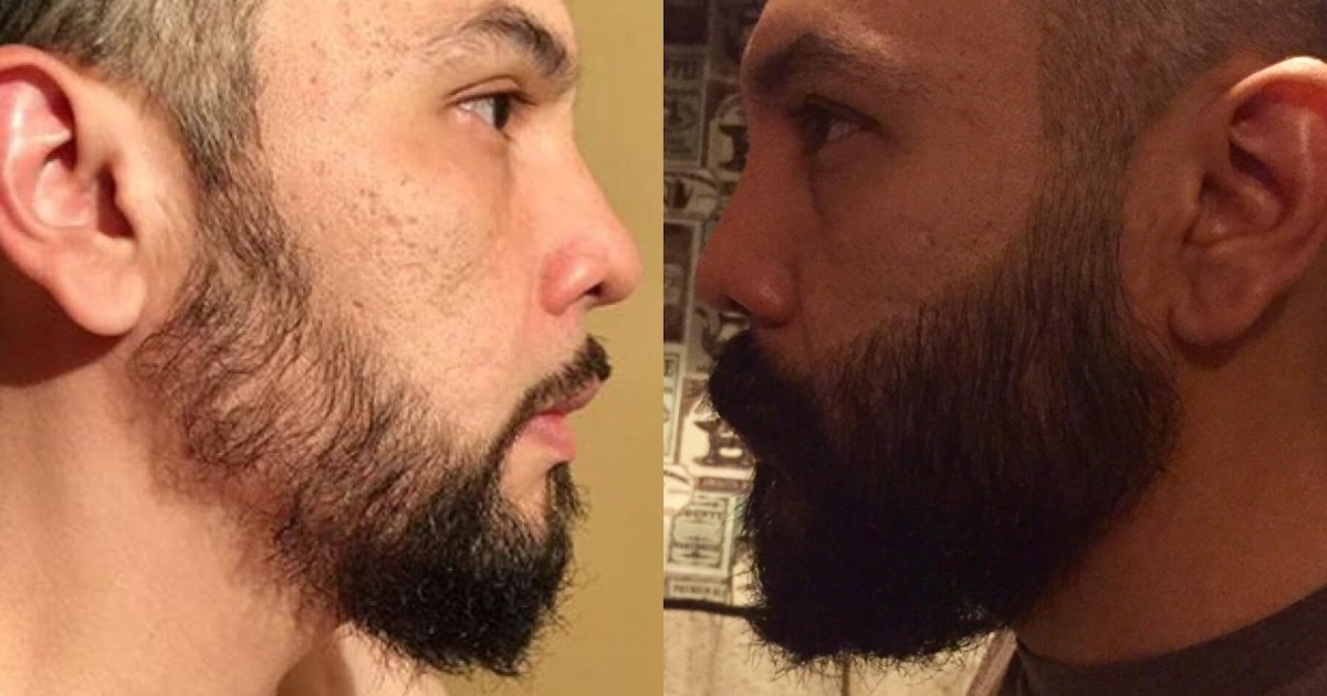 Minoxidil Before And After Beard Result : 1 year minoxidil hair