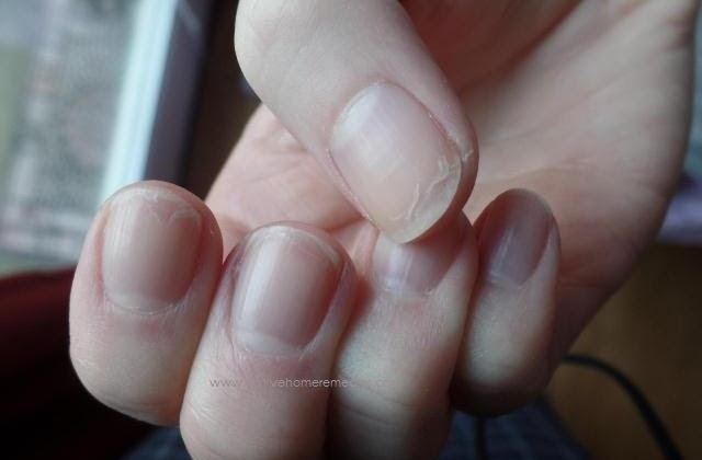 Home Remedies For Brittle Nails