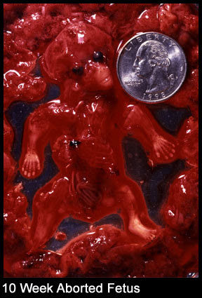 how to abortion in sinhala