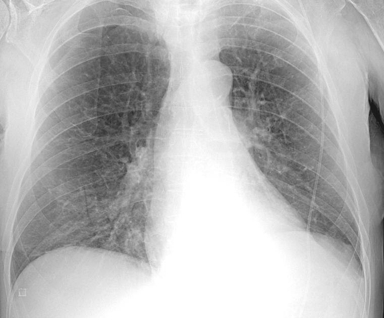 Ispessimento Diffuso Delle Pareti Bronchiali - alidling