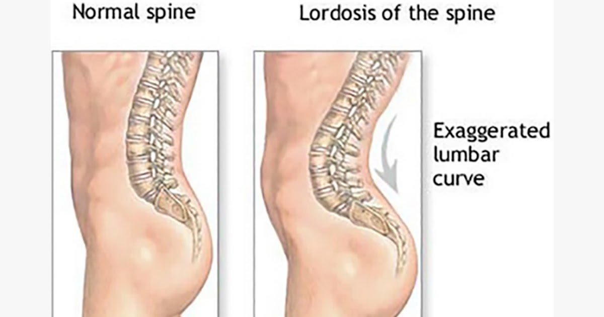 Back Bones Stick Out : Types Of Posture How To Correct Bad Posture