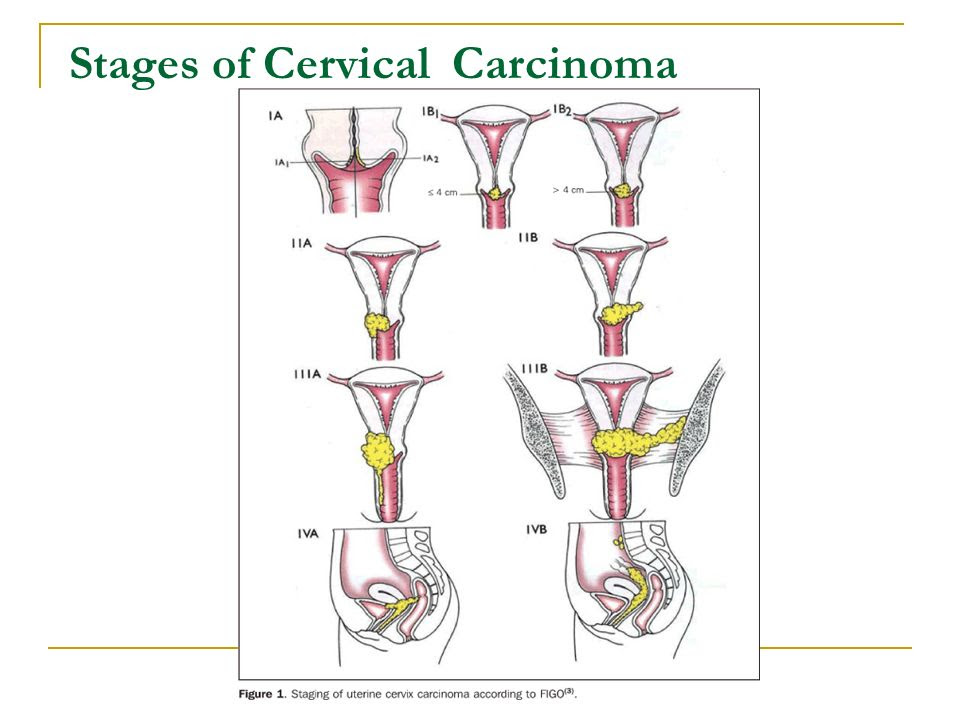 Final stages Of Cervical cancer symptoms - pedalitabuayale