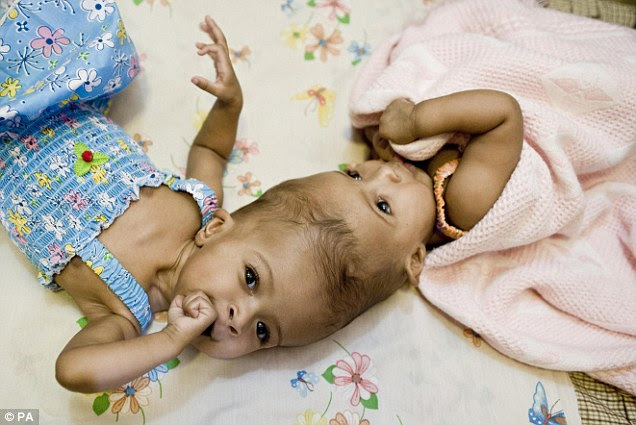 Rital and Ritag, pictured in September. Conjoined twins occur in only one in every 100,000 live births
