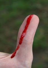 Open cuts like this bleeding thumb cause the need for blood spot or stain removal from clothes