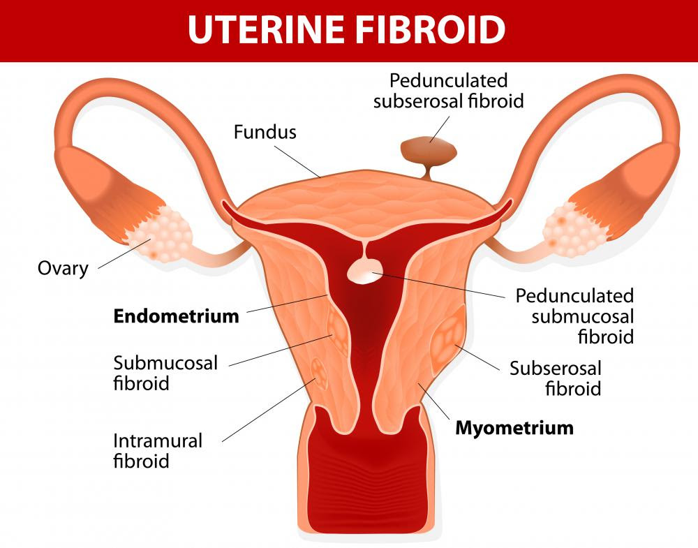 Endometrial cancer Icd 10