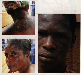 4637_1164463268325_1130188385_492740_3122623_n THIS SOUTH AFRICAN BROTHER AND SISTER ARE REGRETTING BLEACHING NOW!