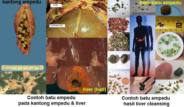 Obat Batu Empedu dan Liver Tanpa Operasi Obat Batu Empedu dan Liver Tanpa Operasi