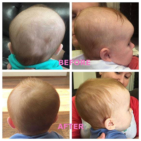Baby Head Helmet Reshape Head Cost helmet