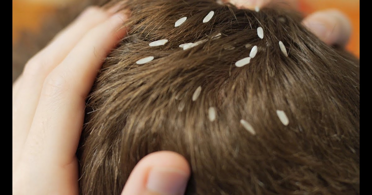 11 Things You Need To Know About Head Lice Infographi vrogue.co