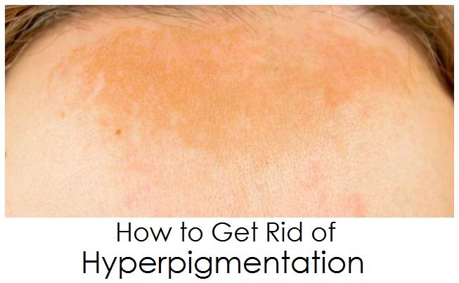 How To Get Rid Of Hyperpigmentation