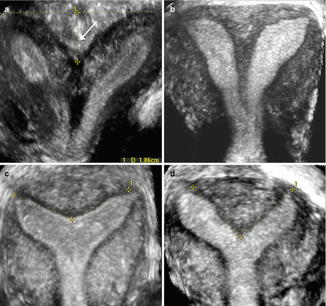 Uterus Didelphys