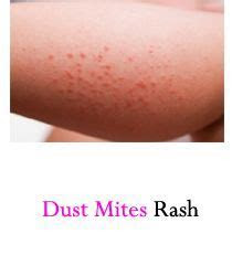 Mold Mite Bites Mold Mite Bites