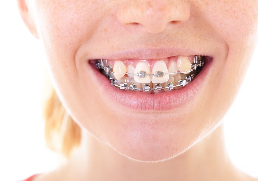 How Do They Put Braces On Crooked Teeth Teeth Poster