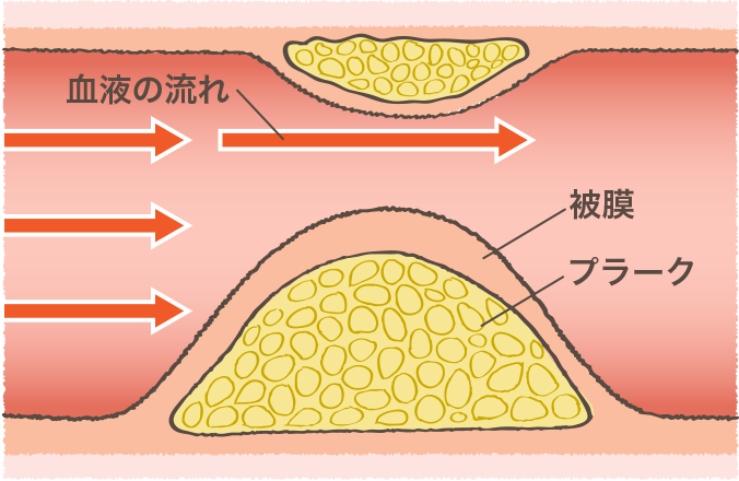 最高のイラスト画像 50 素晴らしい動脈 硬化 イラスト