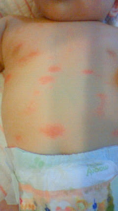 お腹 背中 湿疹 赤ちゃん 赤い 赤ちゃんのお腹・背中に赤い湿疹が！あせもやアトピーの正しい対処【医師監修】
