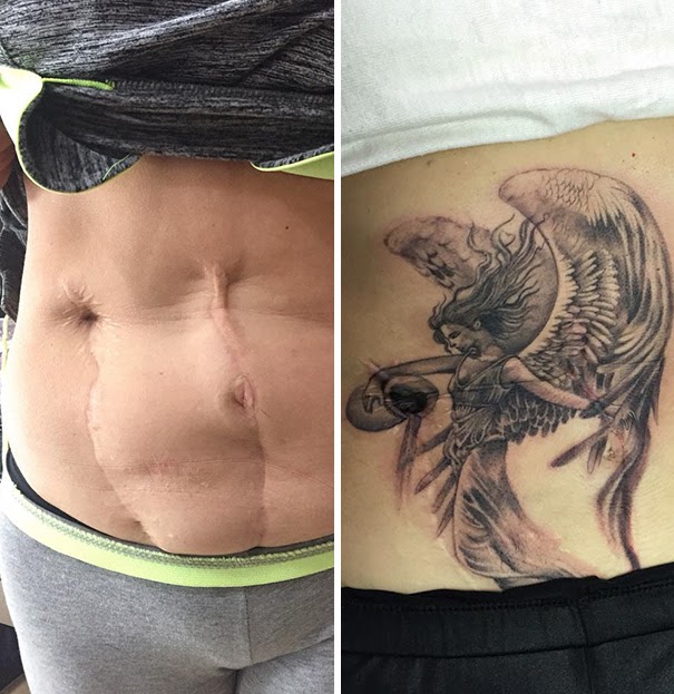 [Get 32+] Tattoo Ideas Cover Up Tummy Tuck Scar