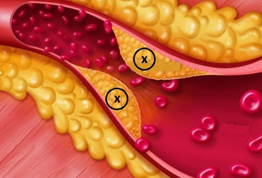 RỐI LOẠN LIPID MÁU VÀ NGUY CƠ BỆNH TIM MẠCH – BV HUYỆN CỦ CHI