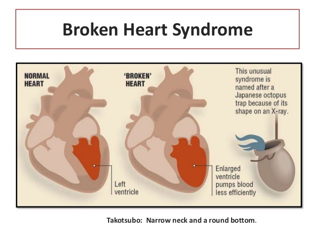 Broken Heart Syndromewhat To Know