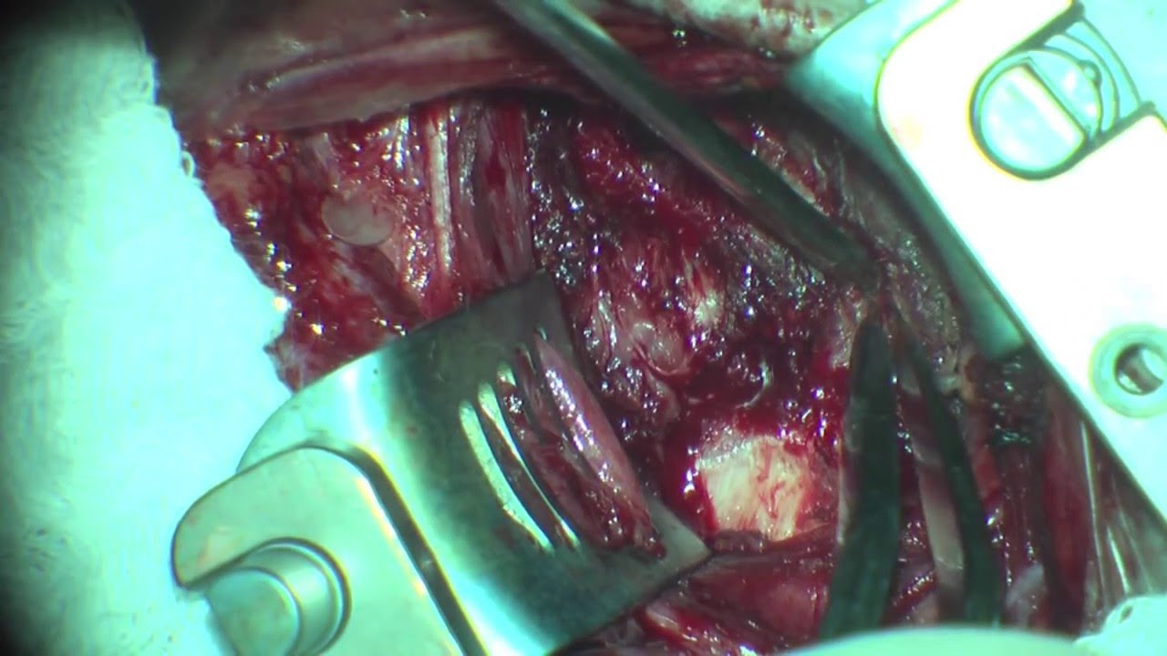 Cervical Herniated Disc surgical procedure