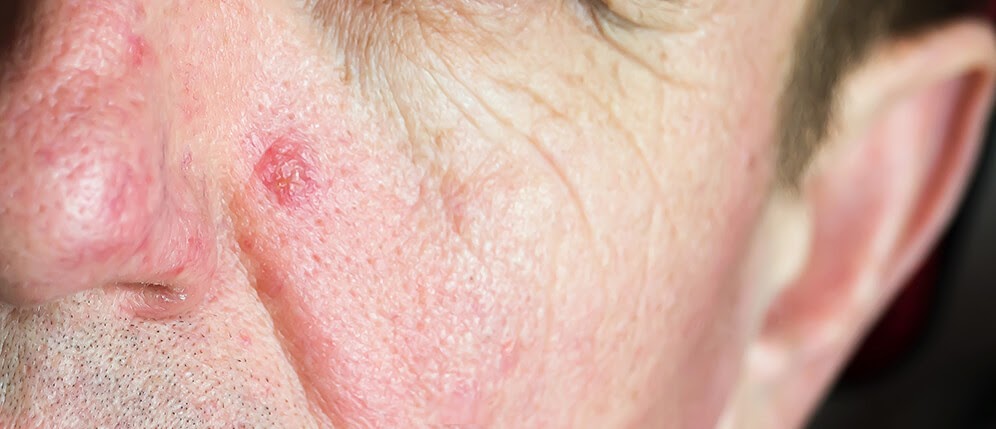 Pdt Behandlung  Hautarztpraxis Dr. Pior Photodynamische Therapie