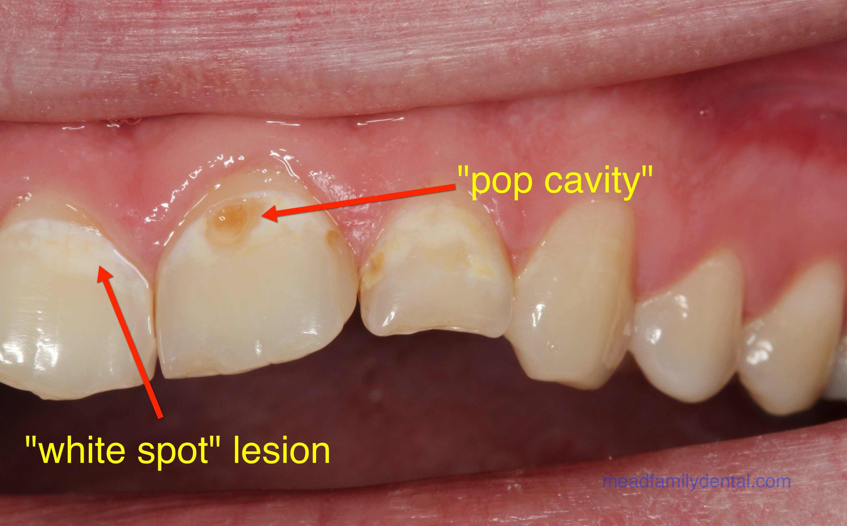 Fixing Tooth Decay In Front Teeth TeethWalls